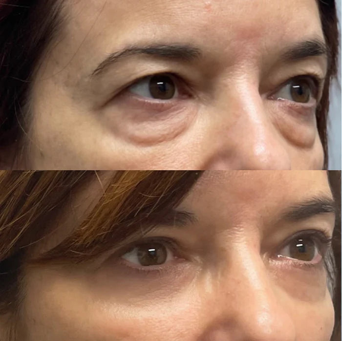 6 Patchs Microneedling Anti-âge